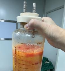邹平水动力吸脂手术要做多久？